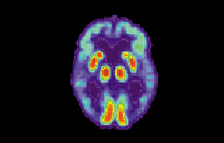 Alzheimer's disease as shown in a brain PET scan