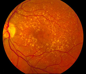 eye with macular degeneration