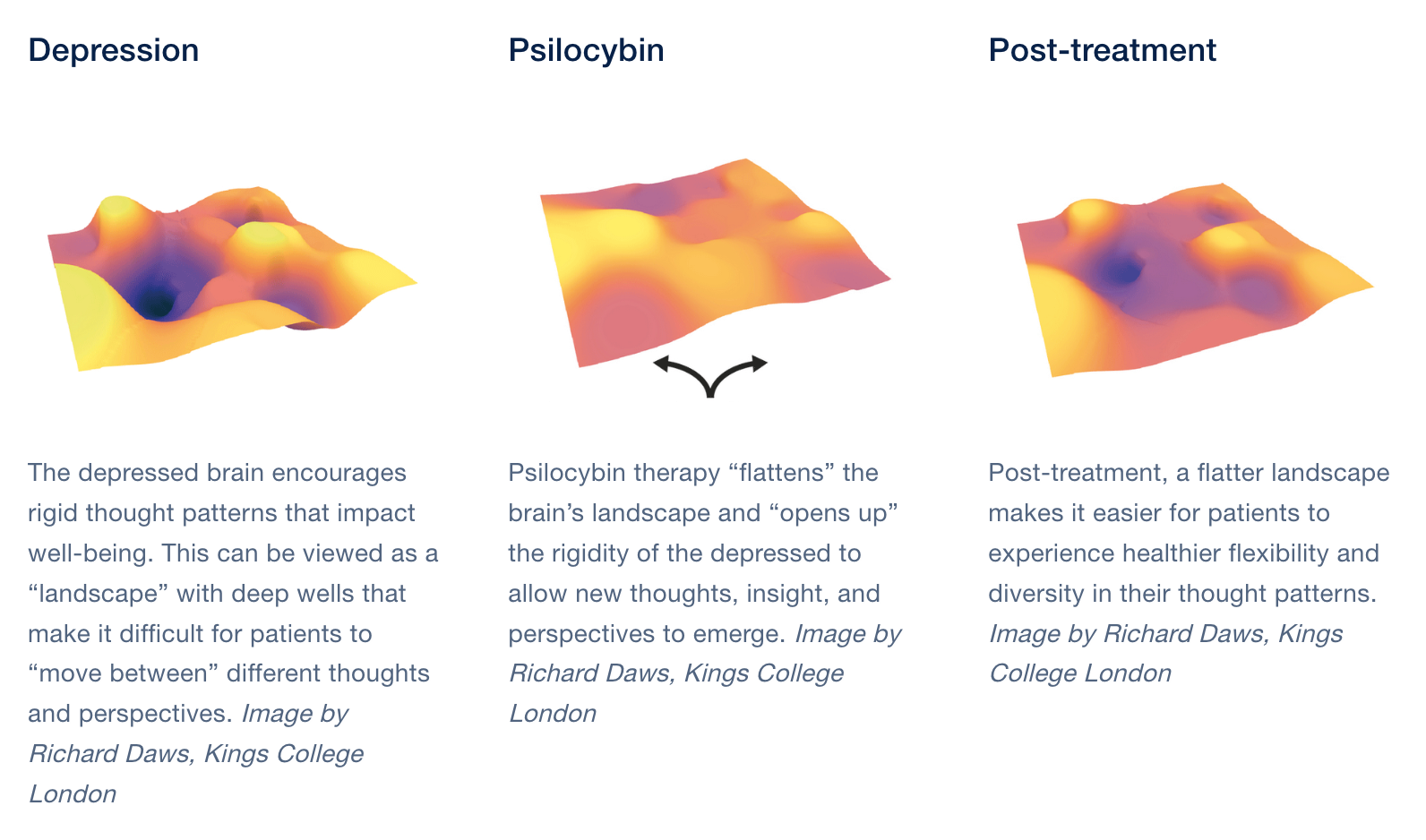 Depressed brain visualizations before, during and after psilocybin treatment