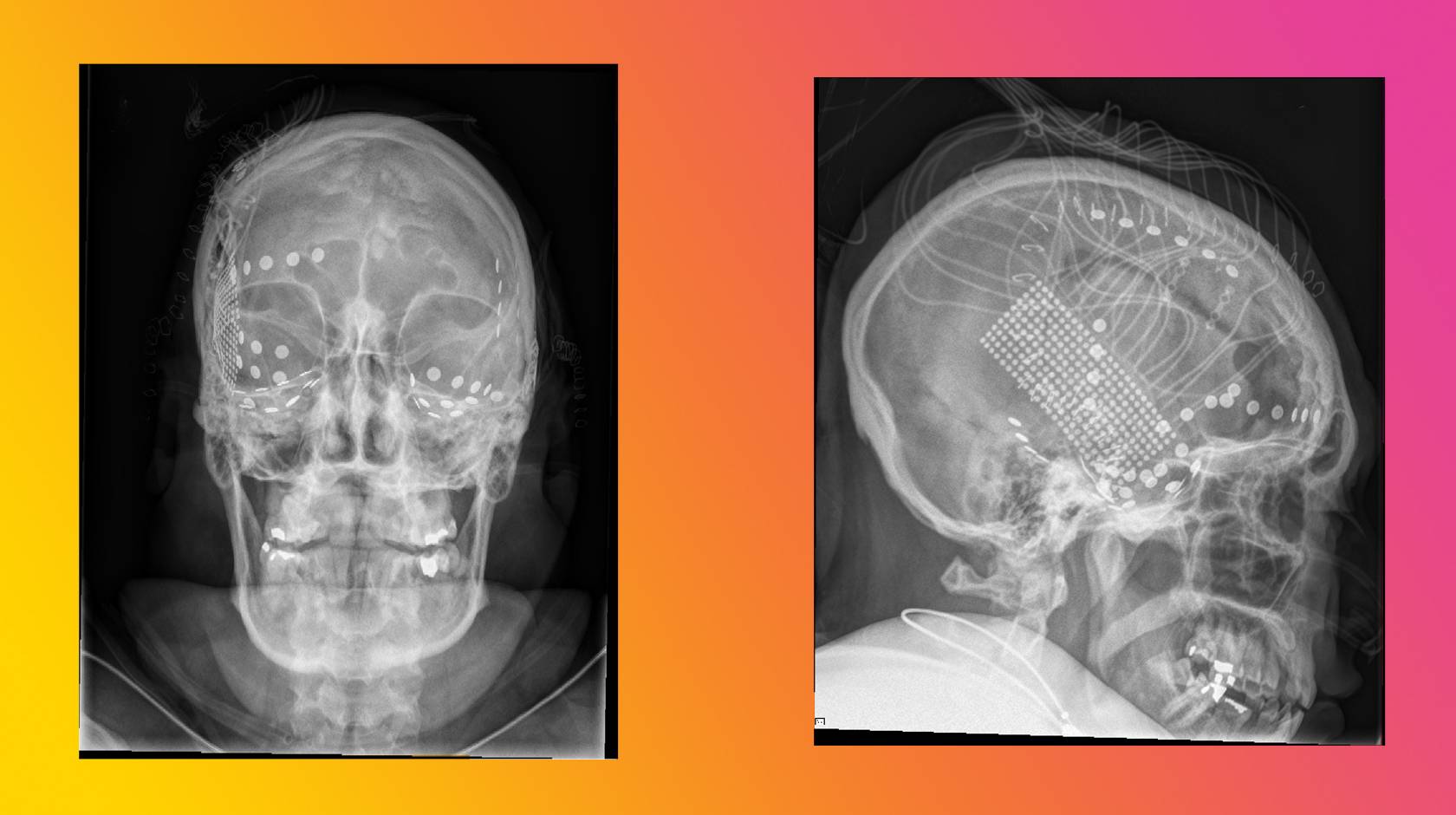 2 x-ray images of a human head showing electrodes attached to a brain