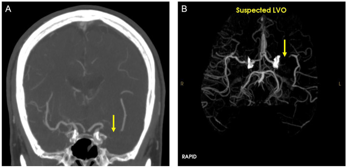 Two grayscale images, one showing a brain with a yellow arrow, another showing a vascular network with a yellow arrow