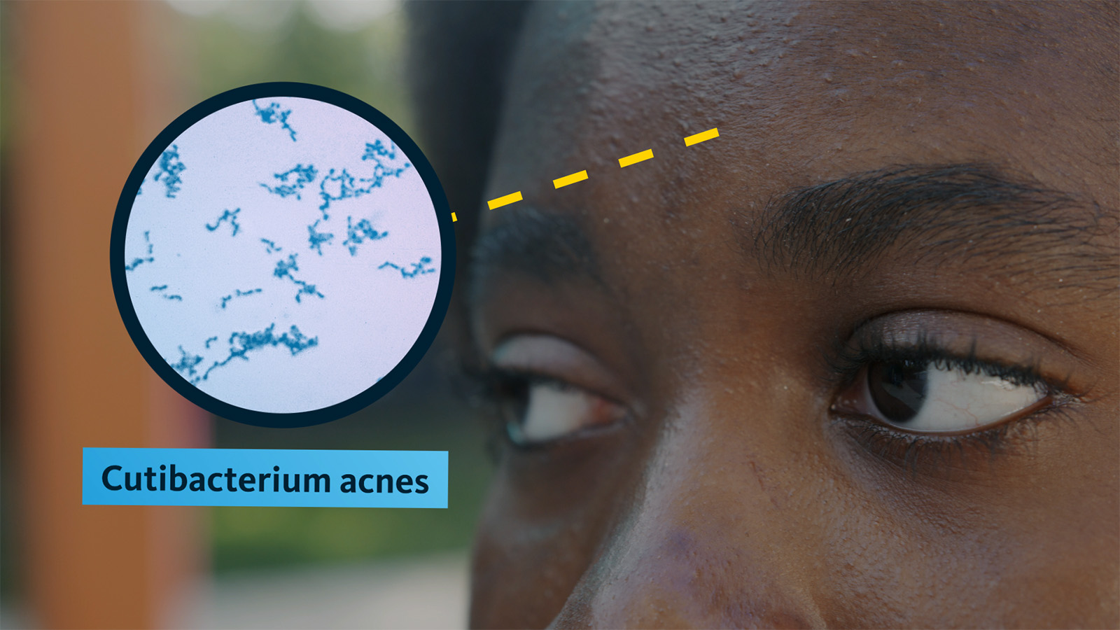 A close-up of a woman's forehead with an illustration showing a microscopic image labeled "Cutibacterium acnes"