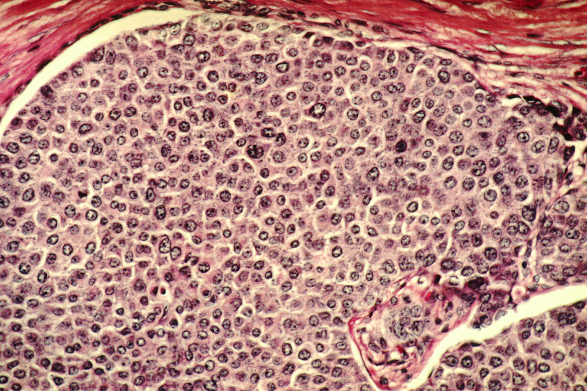 Breast cancer cells