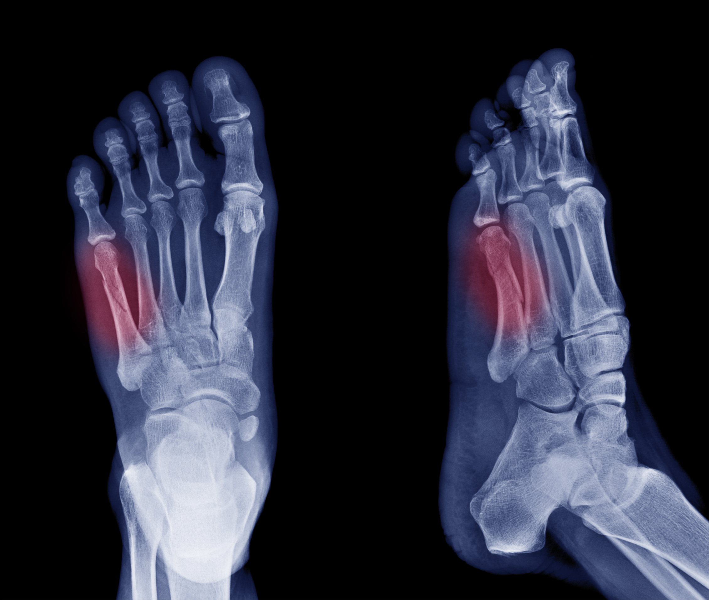 An X-ray of feet with two areas, one on each foot, highlighted in red