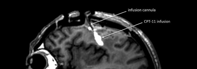 Targeted drug delivery will breach the blood-brain barrier