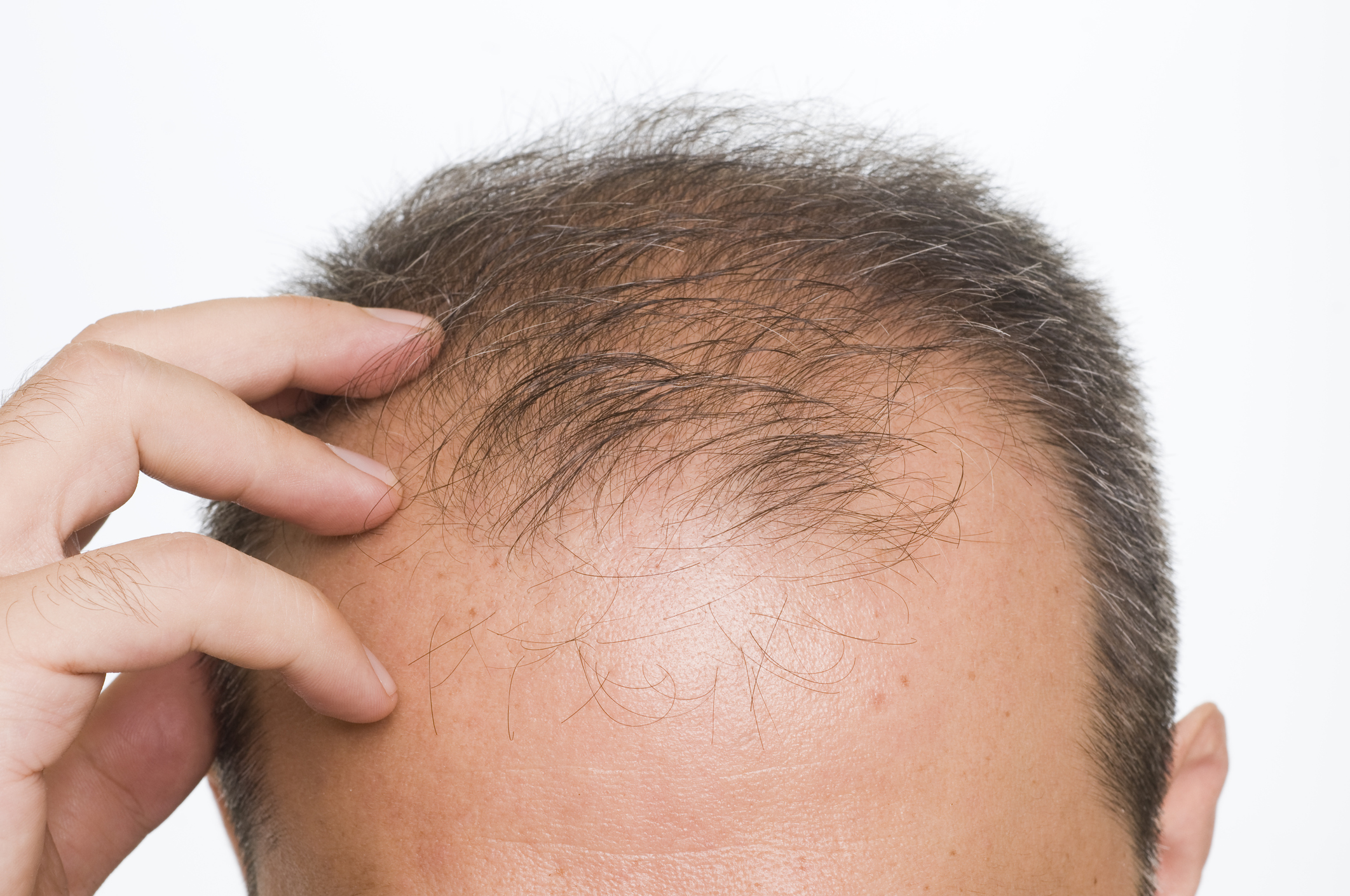 Does Minoxidil Work On Frontal Baldness?