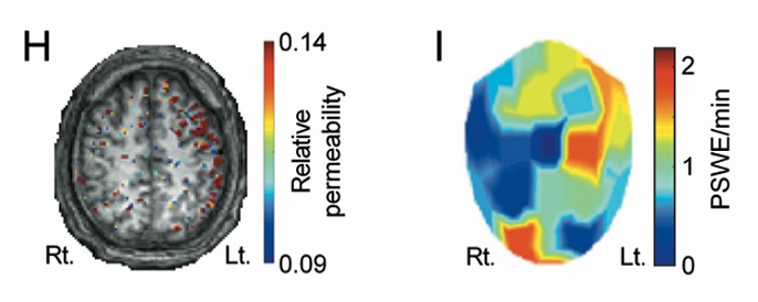 leaky blood brain barrier