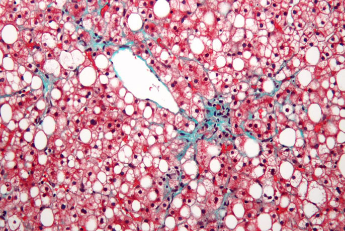 UC San Diego fatty liver disease