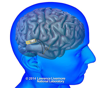 implantable neural device