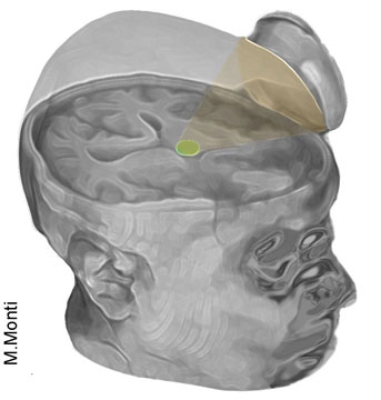 Scientists used a small device to can aim ultrasound at the thalamus in the brain