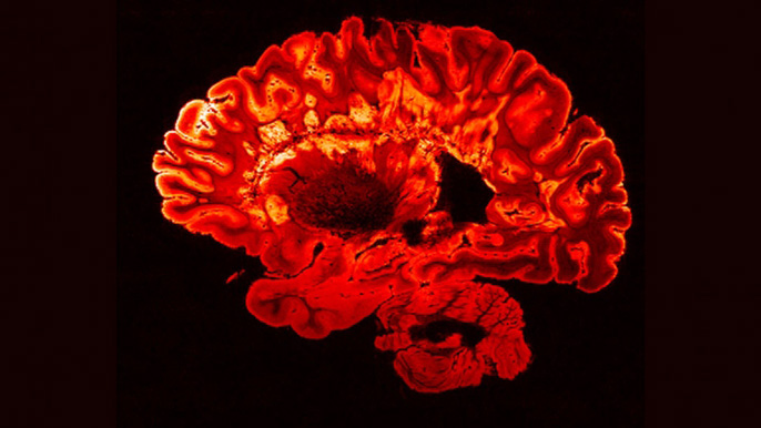 Multiple sclerosis brain scan