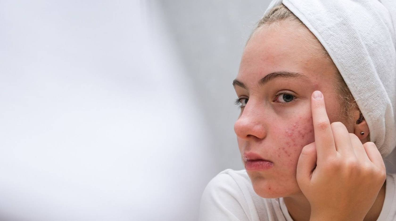 A teen girl with a white towel wrapped around her head and pimples on her face touches her face near her eye