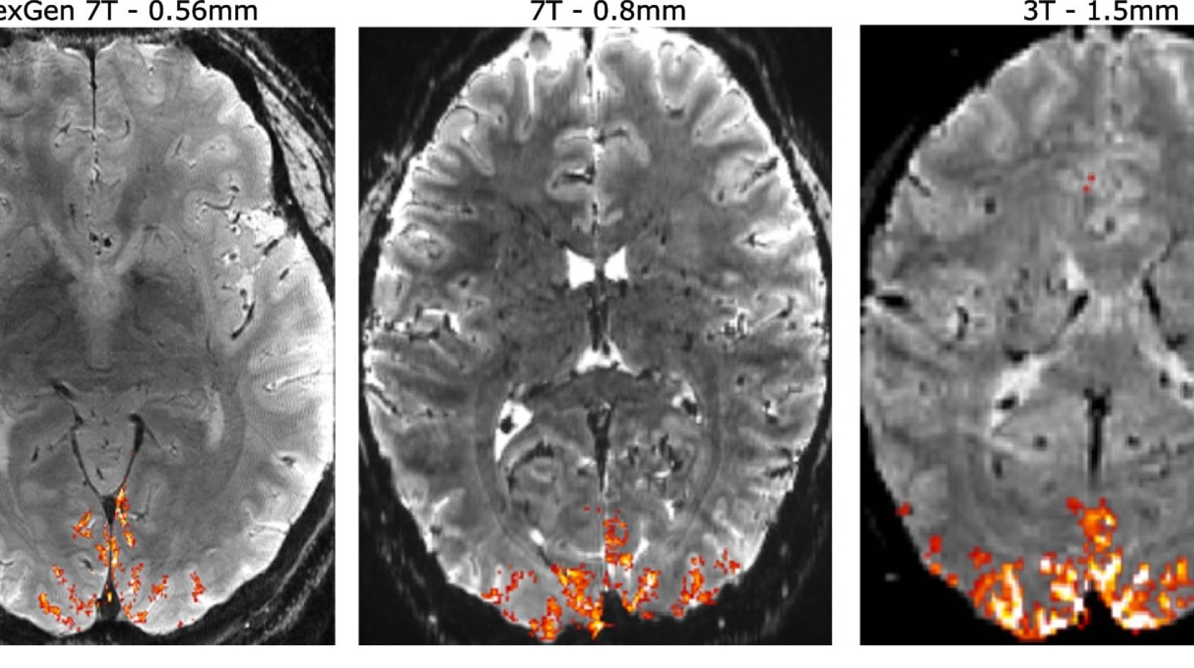 Three MRIs side by side with varying shades of orange at the bottom