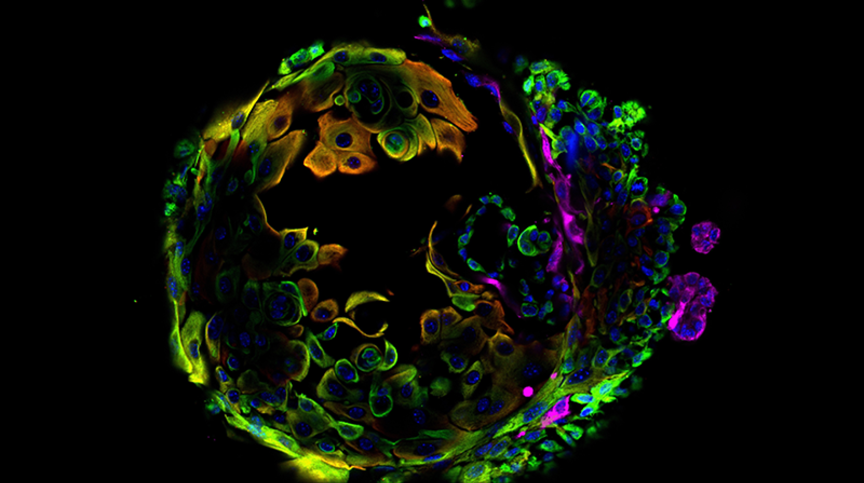 Colorful microscopy showing a breast cancer cell against a dark background