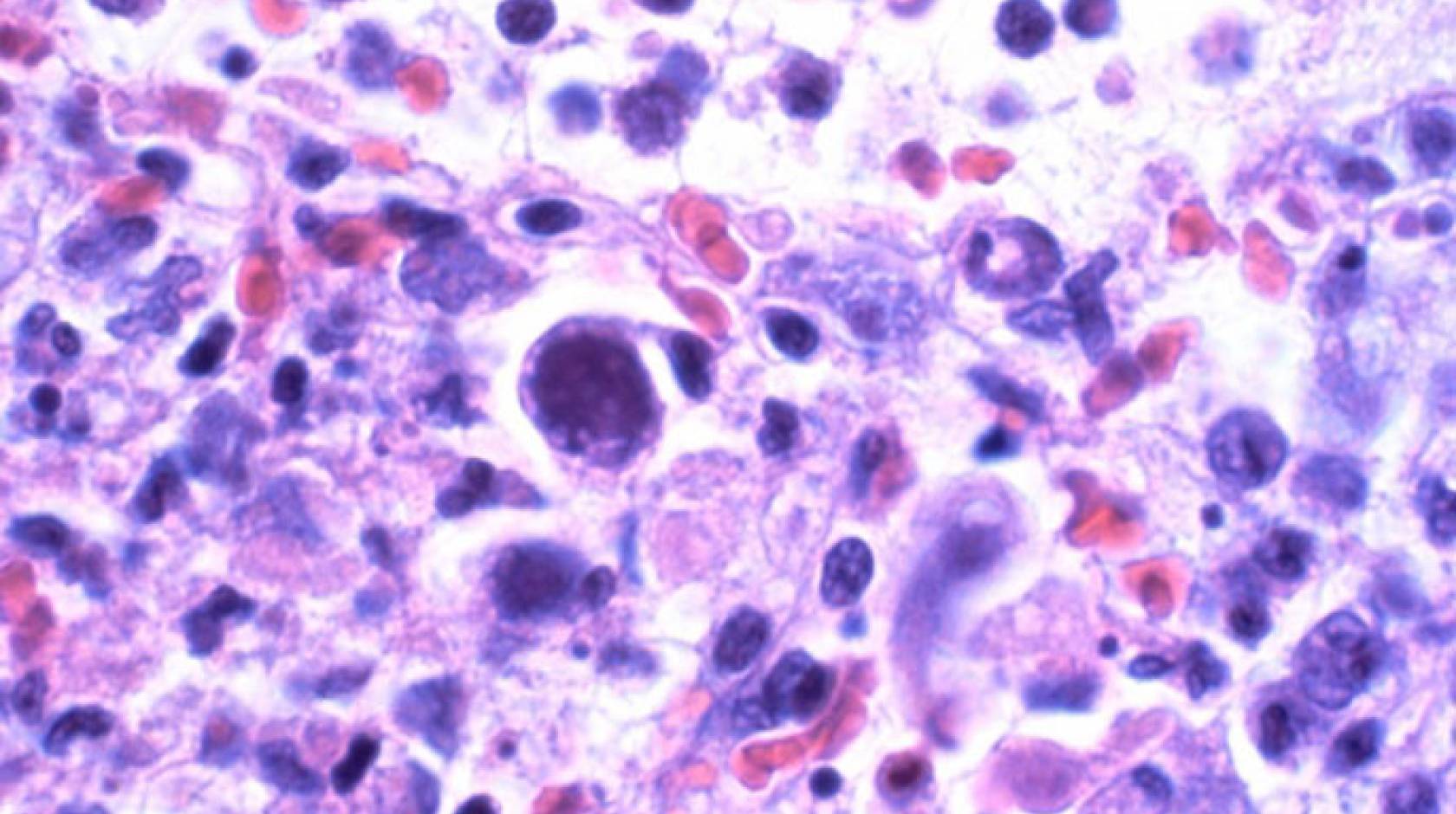 Cytomegalovirus UCSF