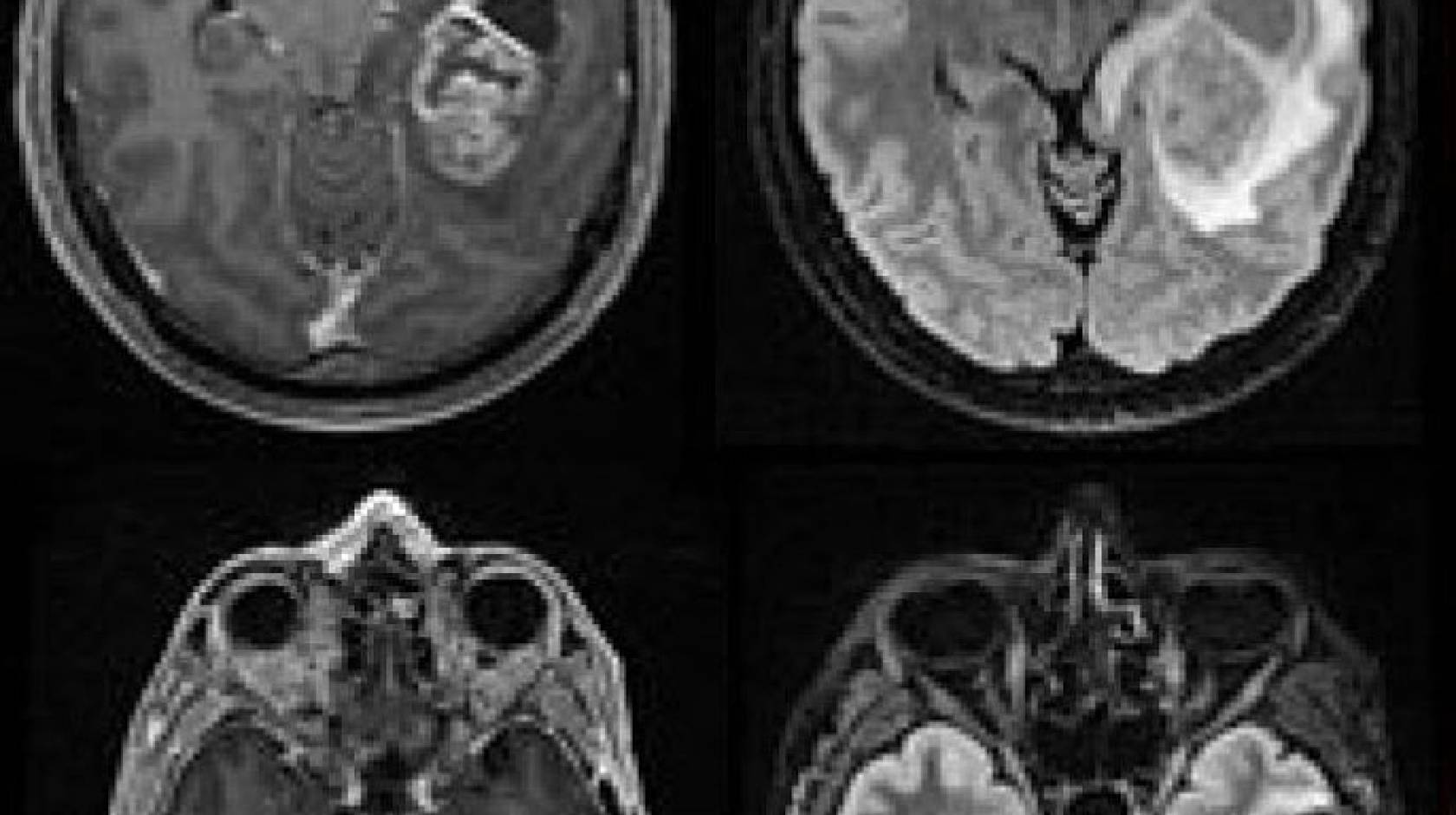 MRI of glioblastomas