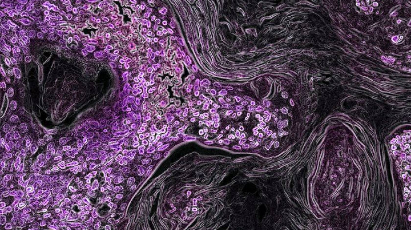 A microscopic image of KRAS-driven lung cancer (purple) in a mouse model