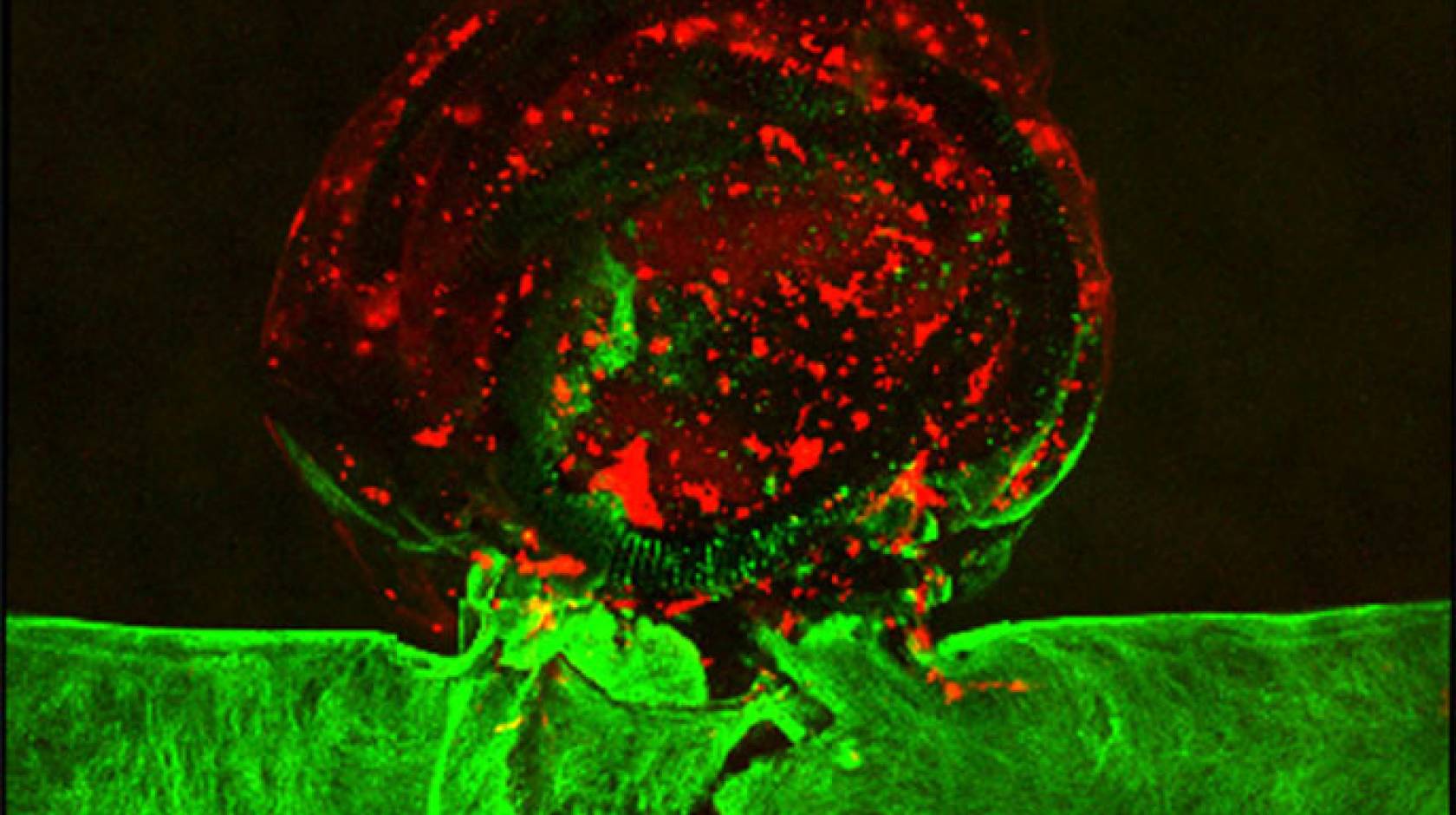 A replicated brain aneurysm