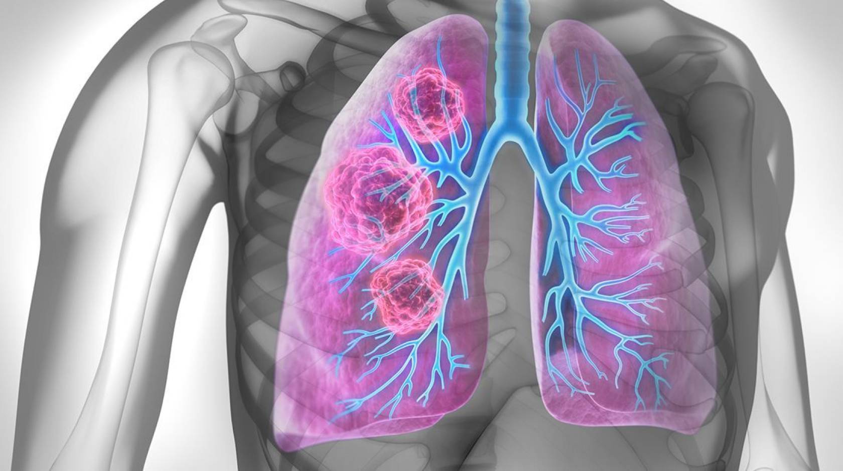 Visualization that looks like an X-ray with pink and blue lungs