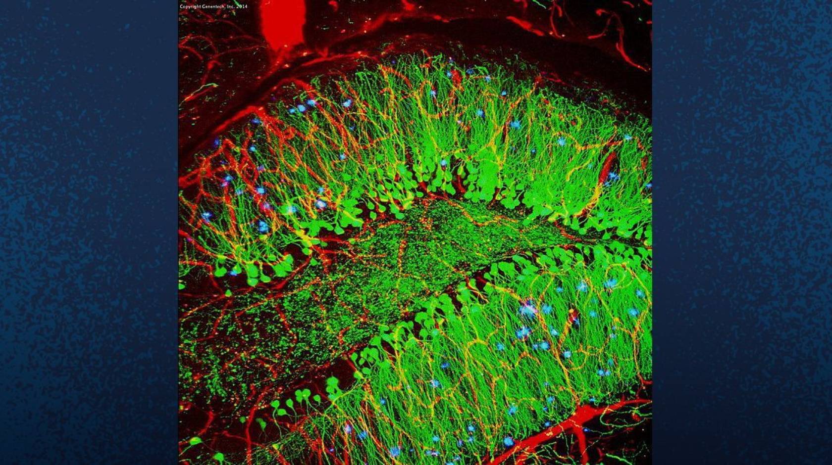 A scan of a mouse brain shows blood vessels (red), brain cells (green), and amyloid plaques (blue). A new gene therapy treatment developed by UC San Diego works by reprogramming the behavior of diseased brain cells.