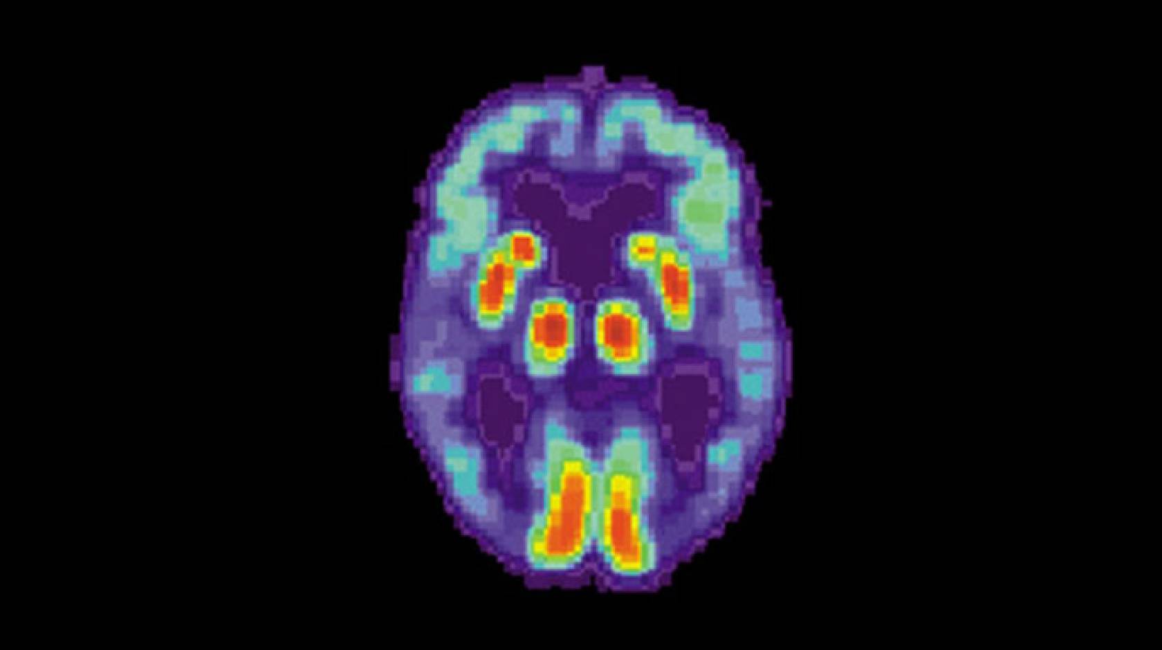 Alzheimer's disease as shown in a brain PET scan