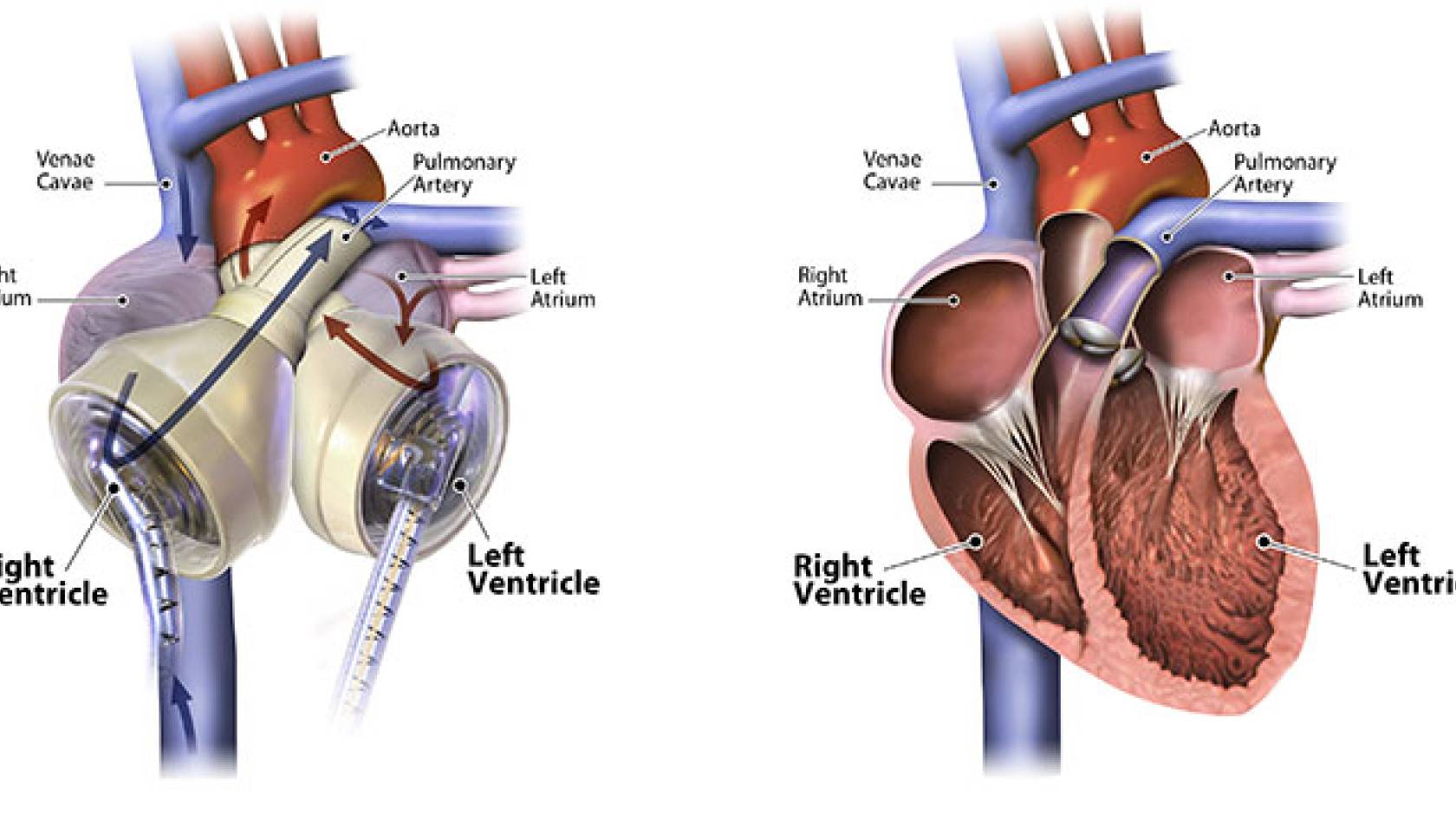 Total Artificial Heart: Procedure and Outlook