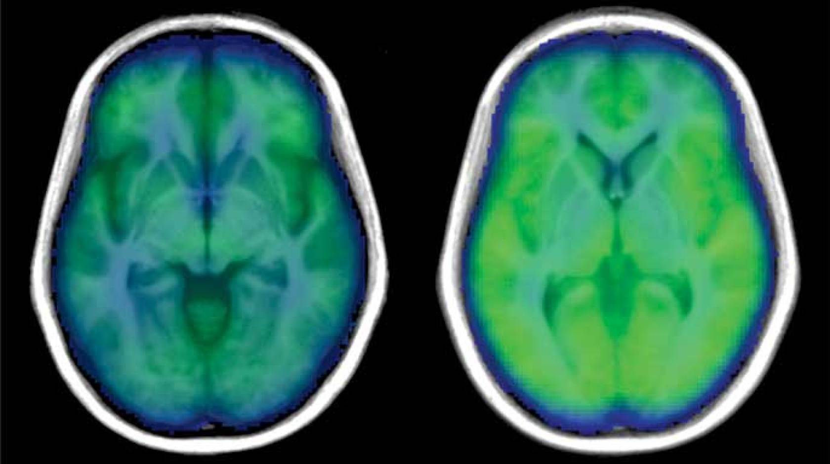 Brain scans: with (left) and without obstructive sleep apnea