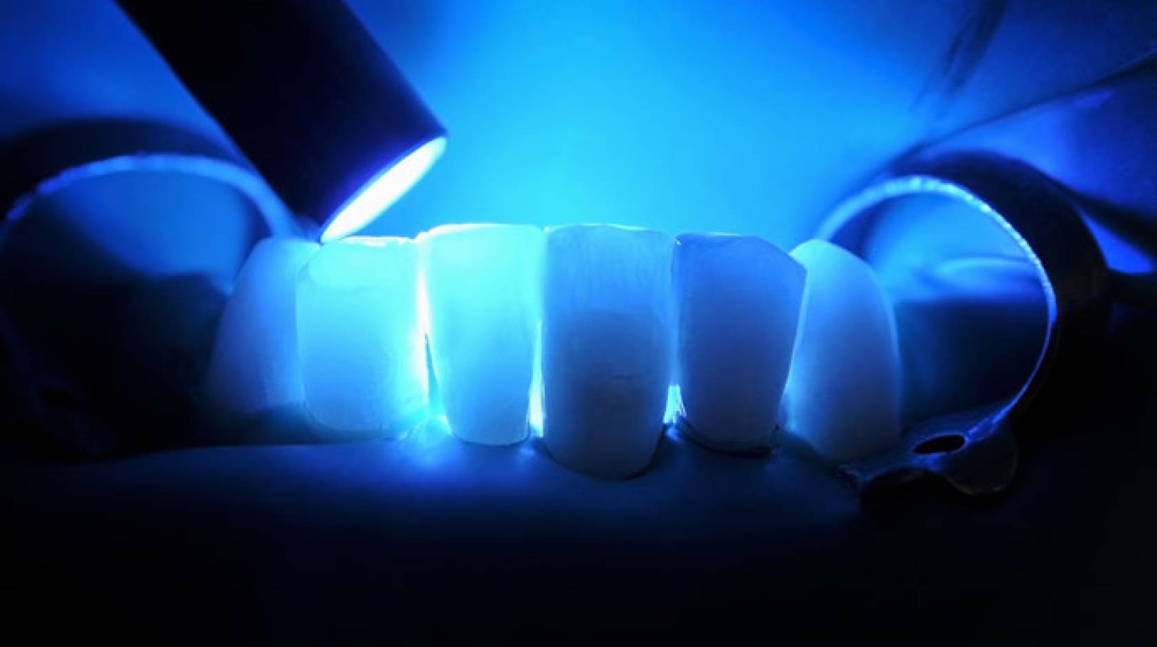 UCSF teeth lasers