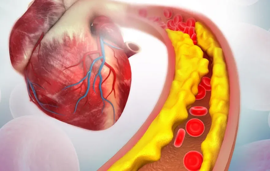 An illustration of cholesterol plaque in a human heart artery.