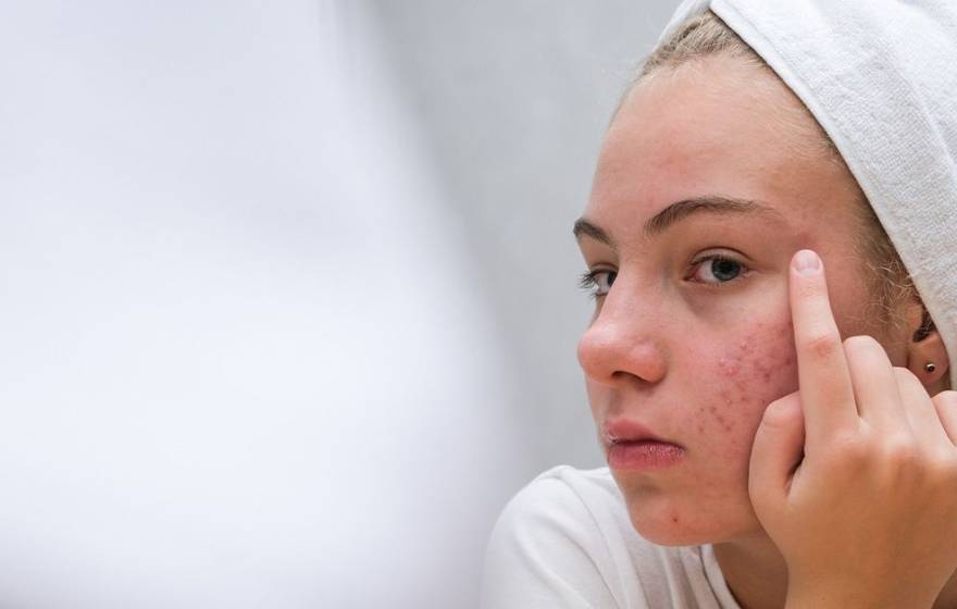 A teen girl with a white towel wrapped around her head and pimples on her face touches her face near her eye