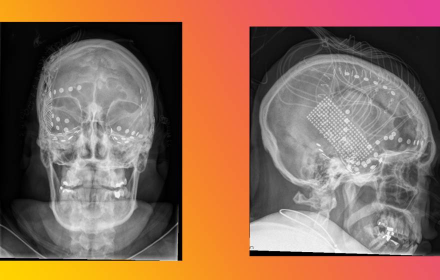 Head X-rays of subjects in the experiment