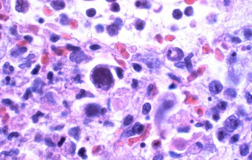 Cytomegalovirus UCSF