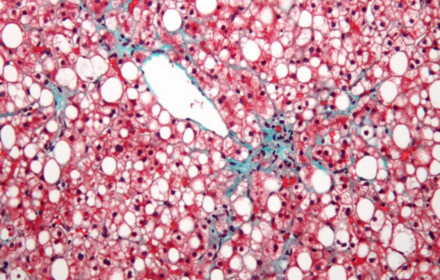 UC San Diego fatty liver disease