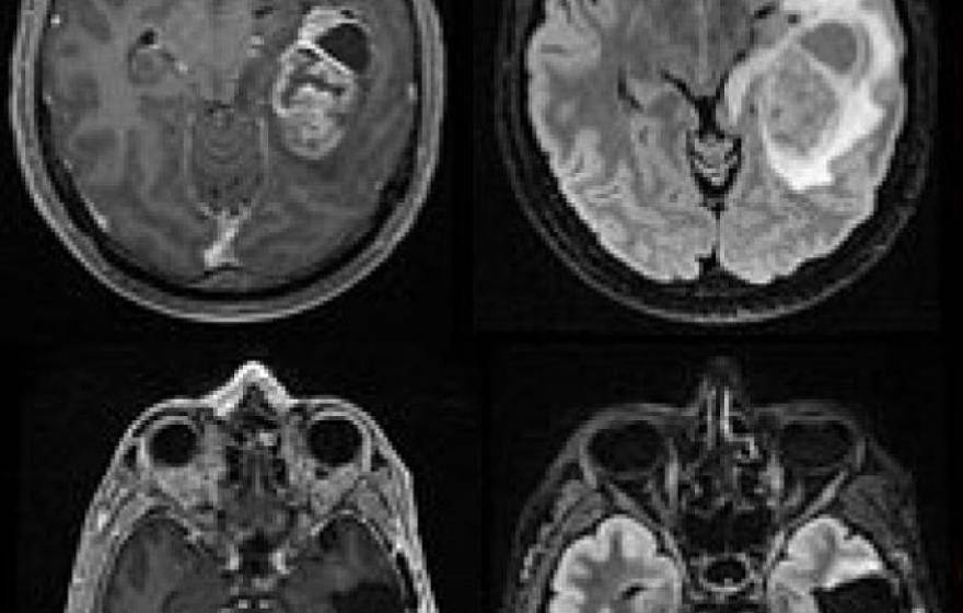 MRI of glioblastomas