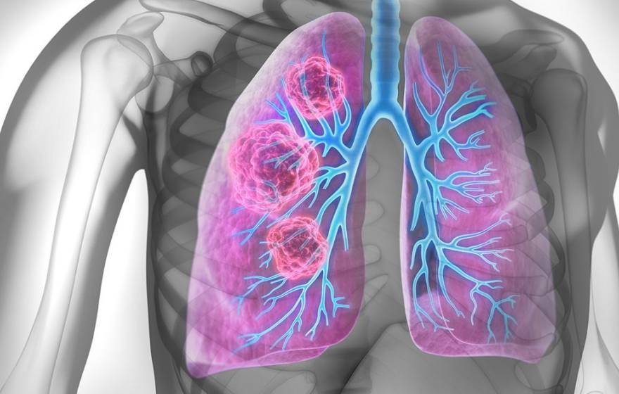 Visualization that looks like an X-ray with pink and blue lungs