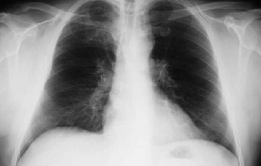 chest X-ray