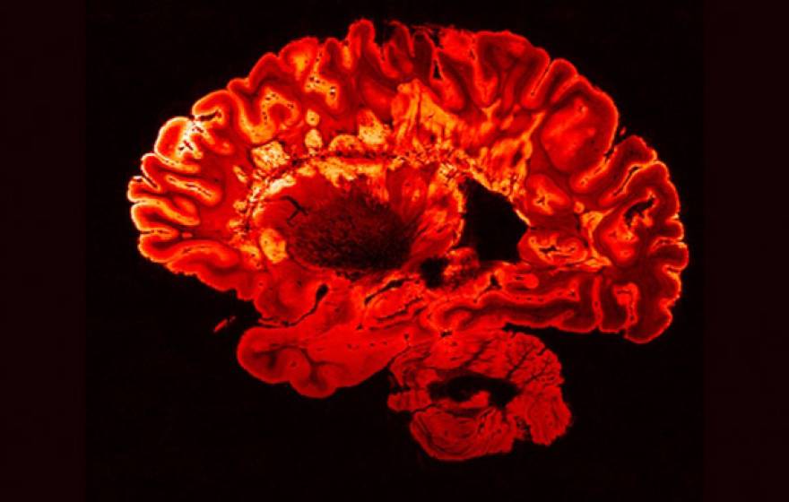 Multiple sclerosis brain scan