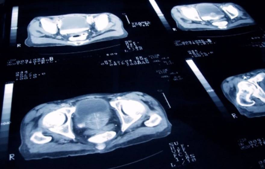 UCSF prostate cancer scan