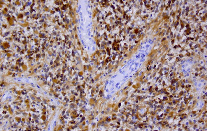 Berkeley Science review brain cancer treatment