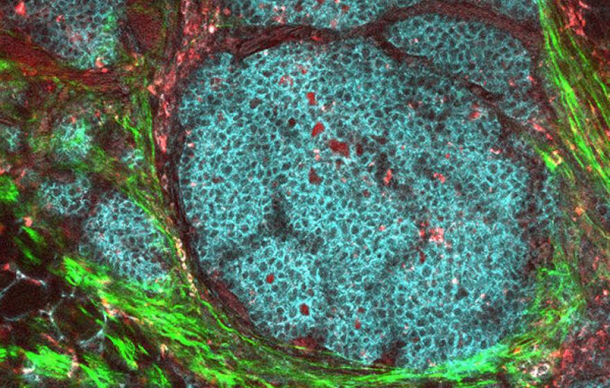 Breast cancer tumor in its microenvironment