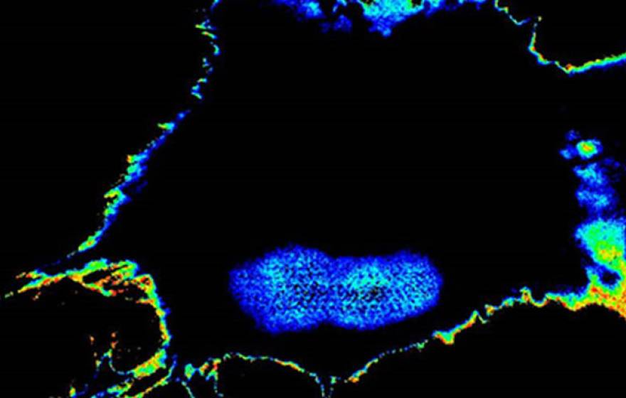 Tumor cell UC San Diego