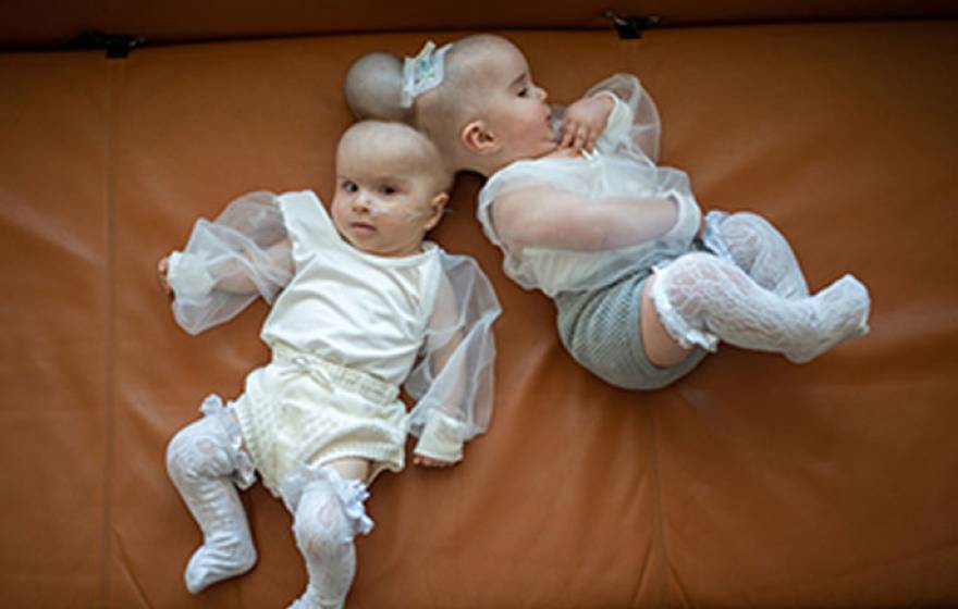 Conjoined twins lying together