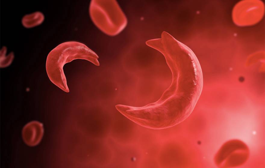 sickle cell