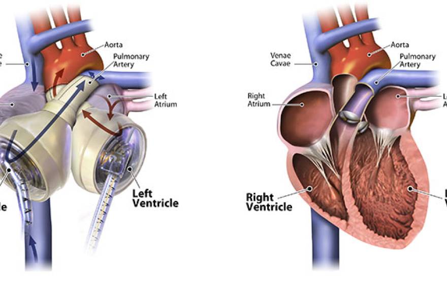 diagram, artificial heart and human heart