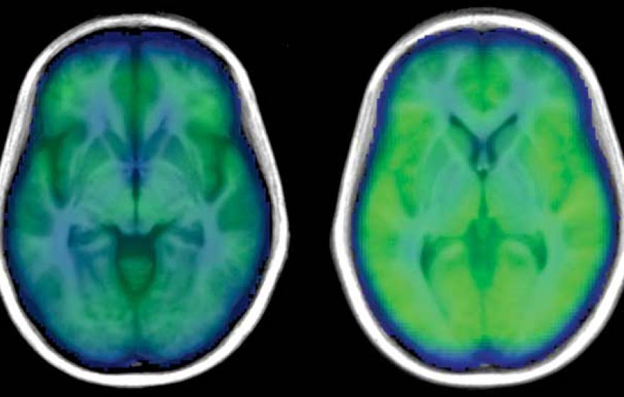 Brain scans: with (left) and without obstructive sleep apnea