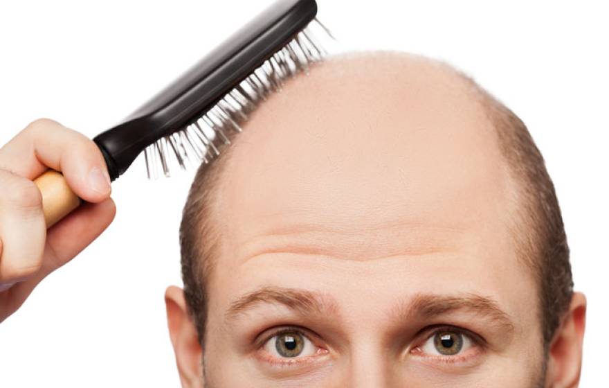 UCSF baldness treatment