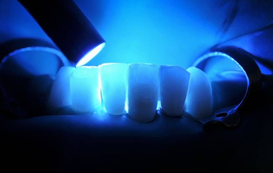 UCSF teeth lasers