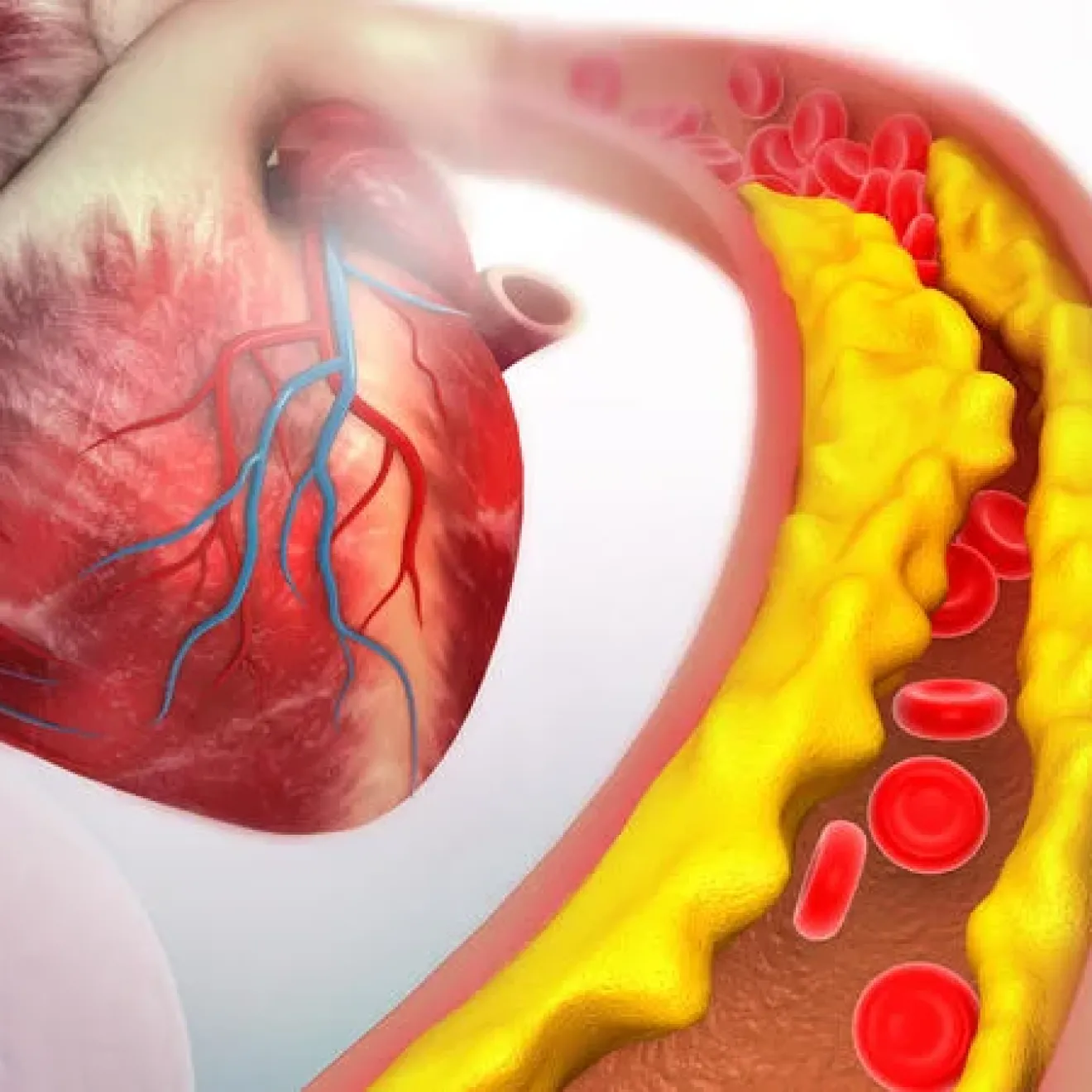 An illustration of cholesterol plaque in a human heart artery.