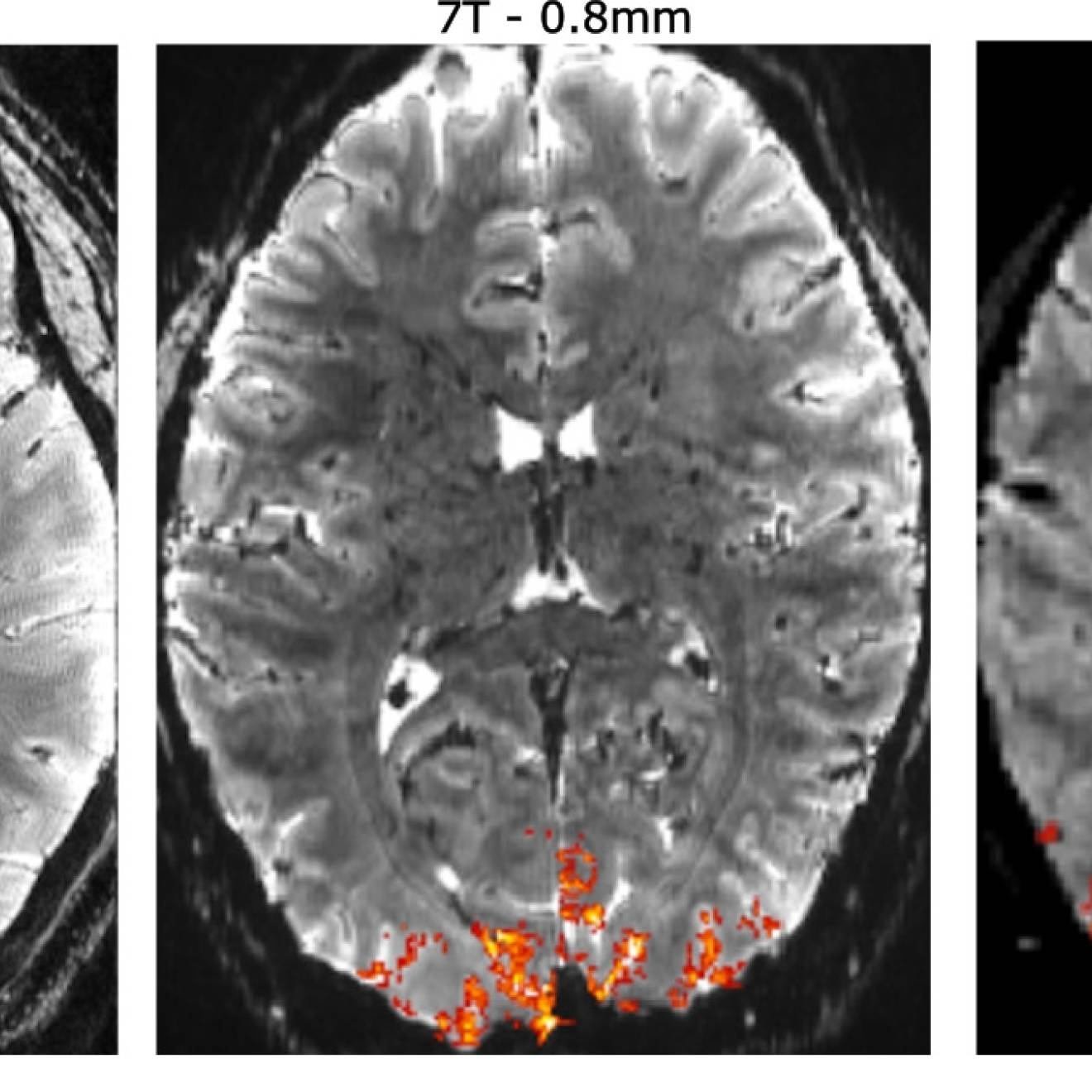 Three MRIs side by side with varying shades of orange at the bottom