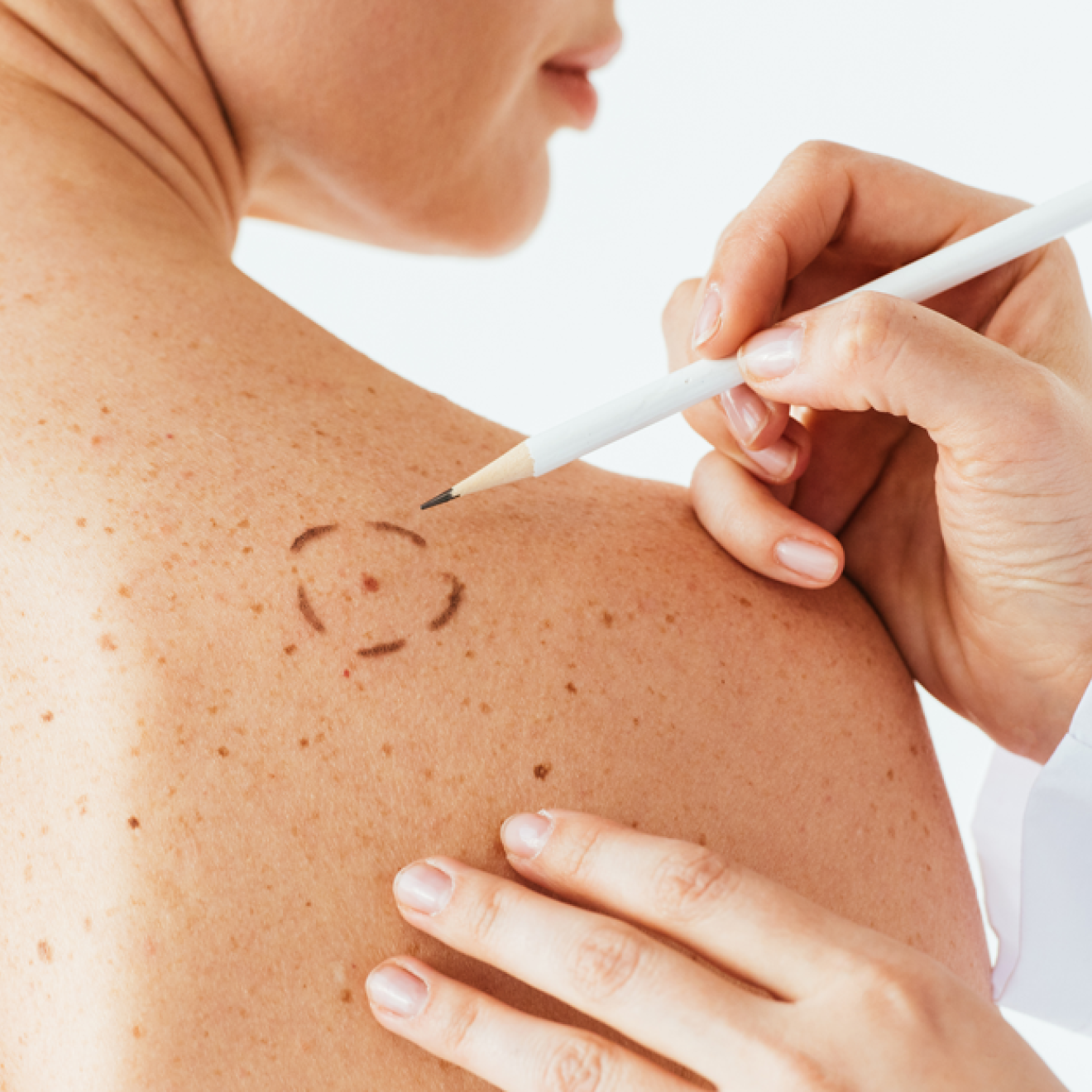 A woman has a spot circled on her back by someone wearing a white coat